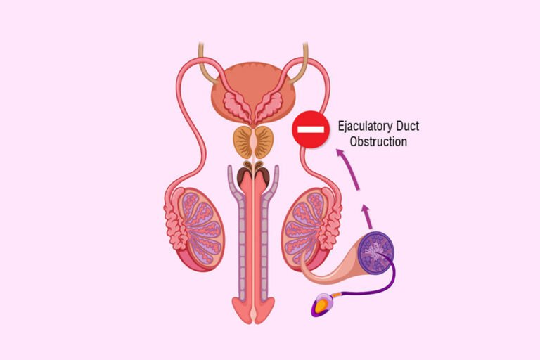 Ejaculatory-Duct-Obstruction_-Causes-Symptoms-and-Treatments