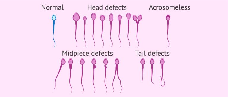 Abnormal Sperm Morphology